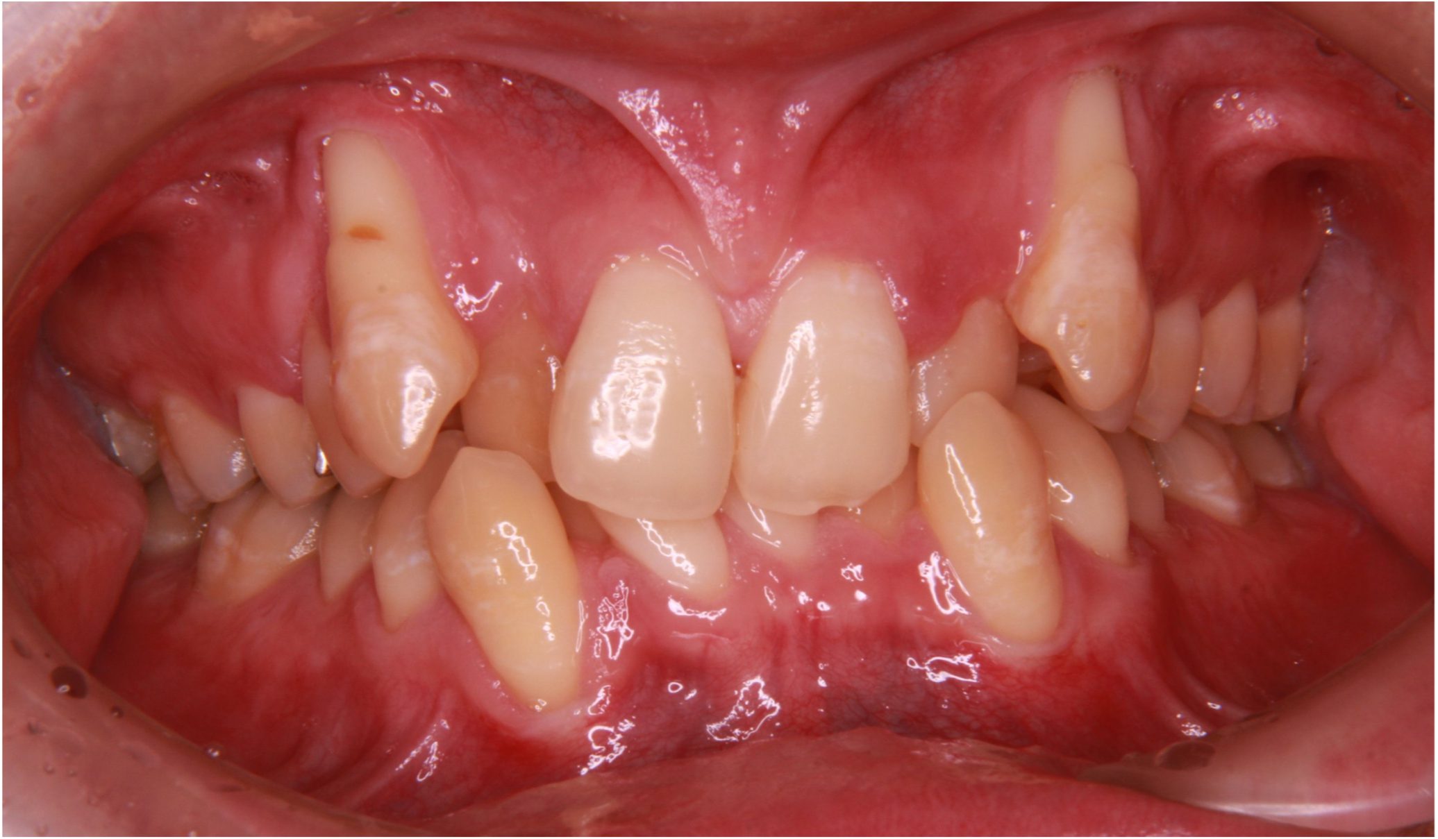 矯正治療と歯肉退縮（歯茎下がり）との関係について