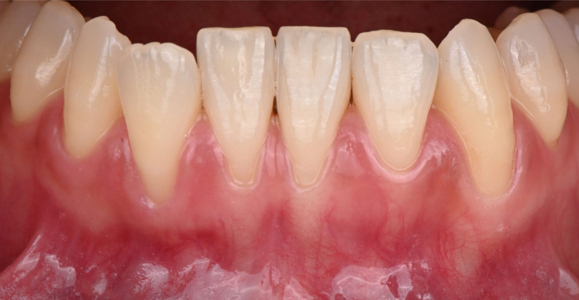 下の前歯の歯茎下がりを治療した症例