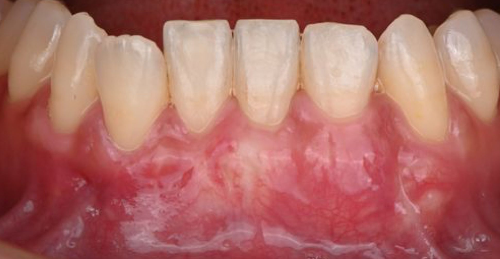 下の前歯の歯茎下がりを治療した症例